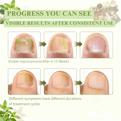 Herbal Toenail Fungus Treatment
