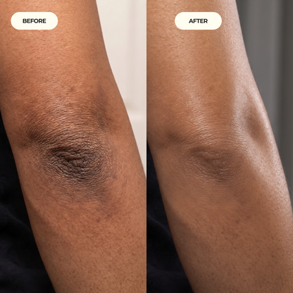 Kojic Acid Turmeric spray - Dark Spot Formula