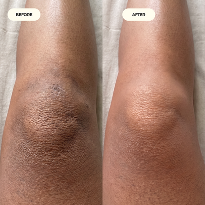 Kojic Acid Turmeric spray - Dark Spot Formula