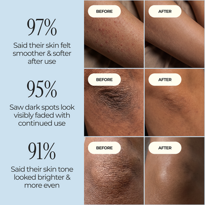 Kojic Acid Turmeric spray - Dark Spot Formula